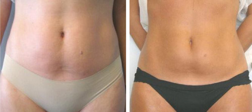 efekt poprawy wyglądu brzucha