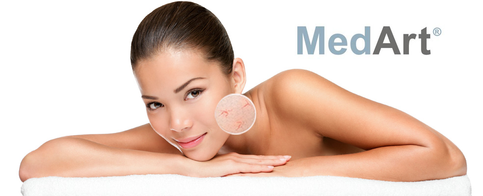 Laserowe zamykanie, usuwanie naczynek na twarzy, ciele Kraków